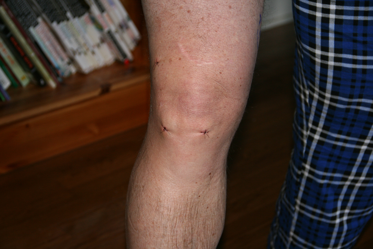 da knee 2012  ~~  torn, MCL, pathology & arthritis on knee cap, quad tendon tear, two mincus tears and some pieces floating around.  2 hours of scope!