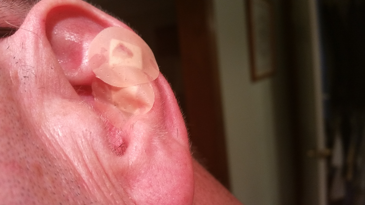 two ear biopsy  ~~  Too much 