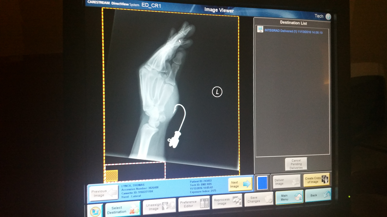Packing up Akula at Old Man's Boatyard  ~~  X-ray from Mather Hospital, a little mistep and we slipped and fell into the nav station where I had laid the fishing rods and my lure.    I caught myself - ouchie!!!!!