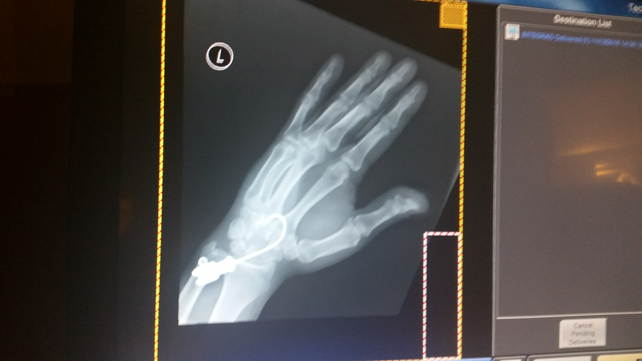 Packing up Akula at Old Man's Boatyard  ~~  X-ray from Mather Hospital, a little mistep and we slipped and fell into the nav station where I had laid the fishing rods and my lure.    I caught myself - ouchie!!!!!
