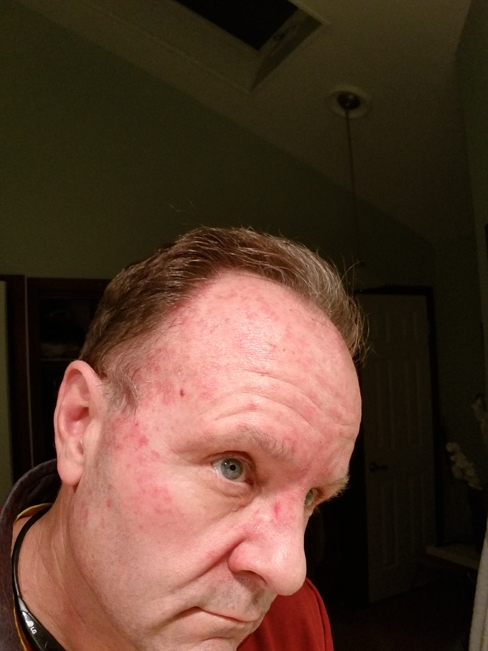 Carac Flourcil Skin Cancer Treatment (3rd time in the last 5 years.  ~~  Decades of lifeguarding, grounds maint, sailing, Jersey Shore, Golf and basically Irish skin and Ban De Sol a getting the Savage (ravaged) tan.