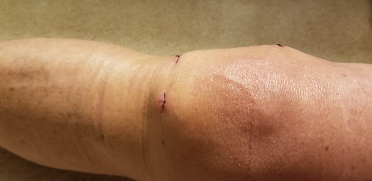 2nd miniscus operation in 2019 (last one was 2013)   ~~  