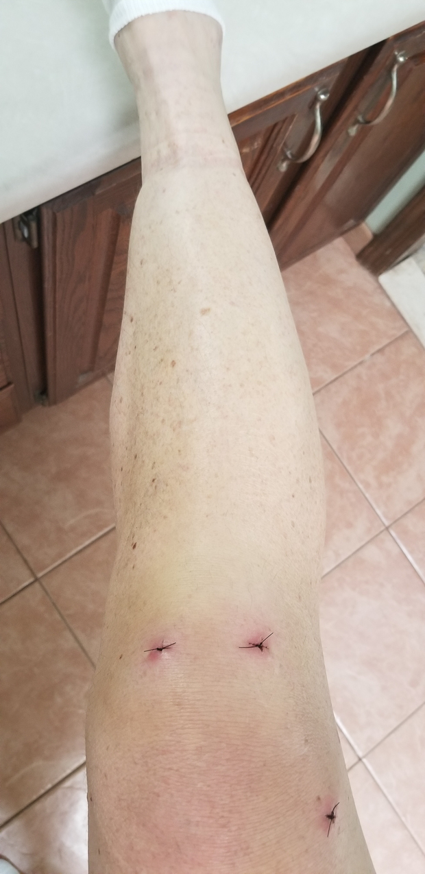 2nd miniscus operation in 2019 (last one was 2013)   ~~  