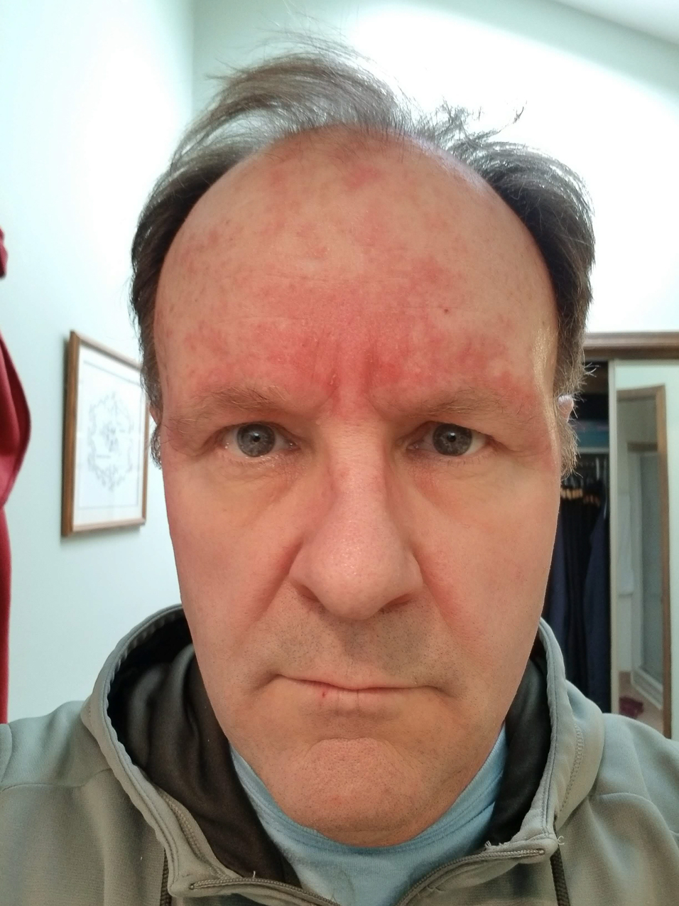 CARAC Cancer Chemo   ~~  Day 18