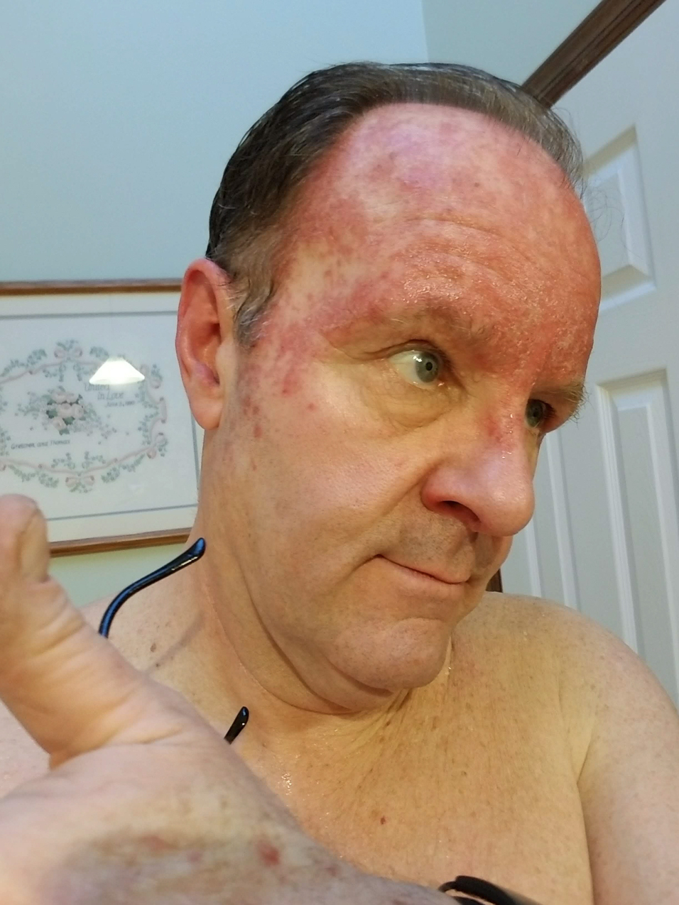 CARAC Cancer Chemo   ~~  LAST DAY 24 - ouchy