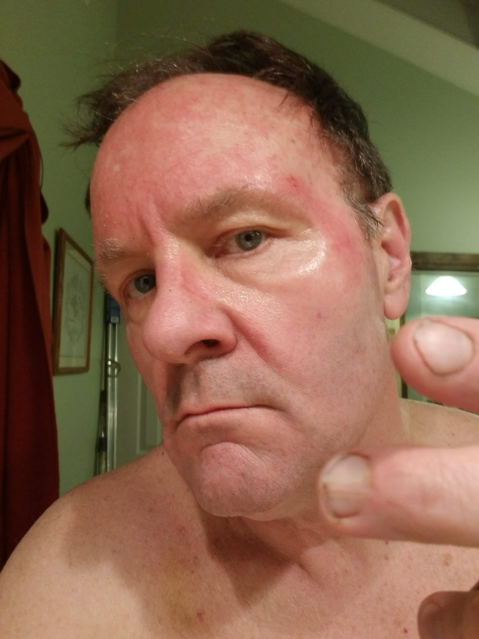 CARAC Cancer Chemo   ~~  Two days of recovery