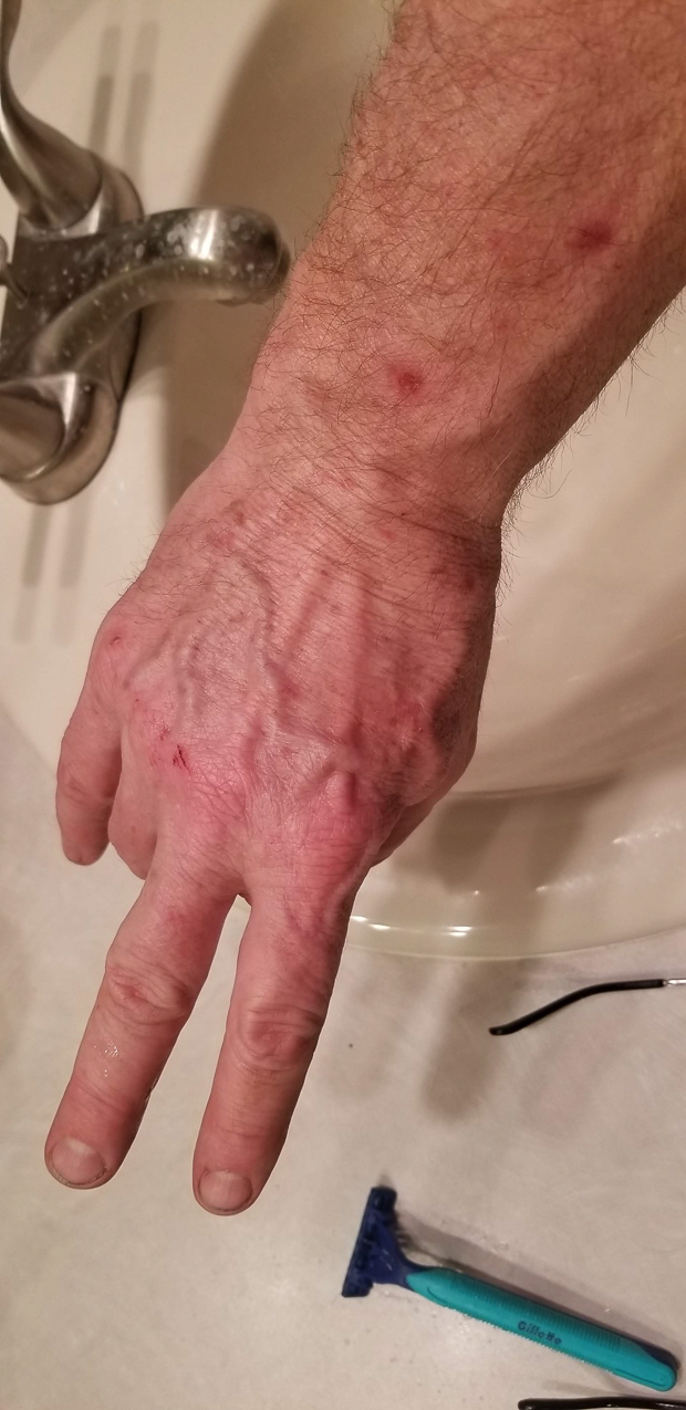 CARAC Cancer Chemo   ~~  Two days of recovery