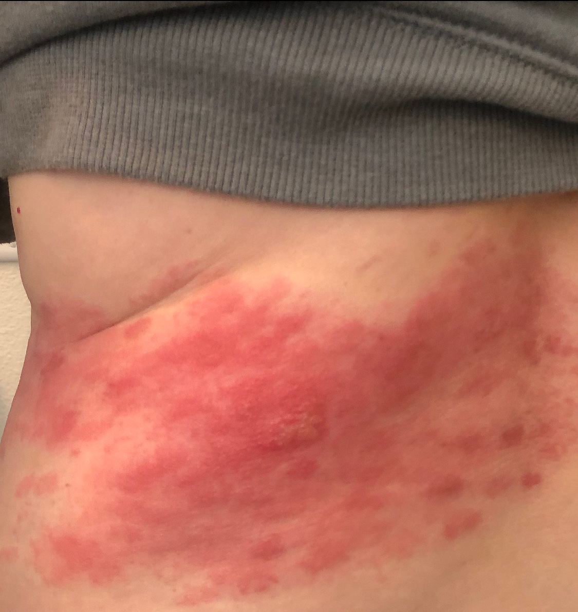 Gretchen Shingles NOV 2021  ~~  Not fun <tear>