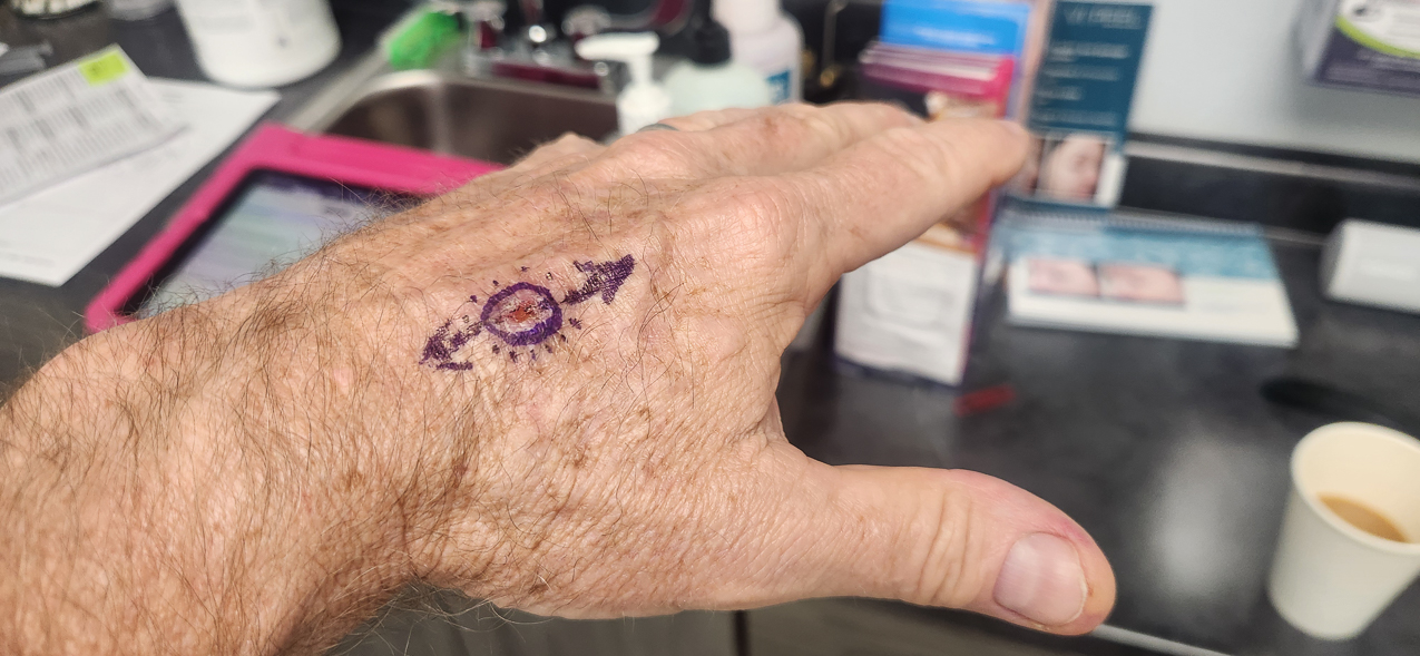 Squamous Cell Caner on my left hand  ~~  Ouchie for days!!!