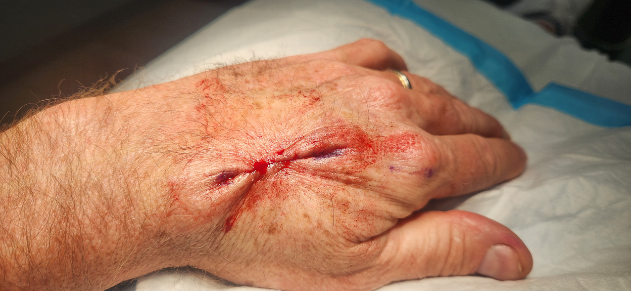 Squamous Cell Caner on my left hand  ~~  Ouchie for days!!!