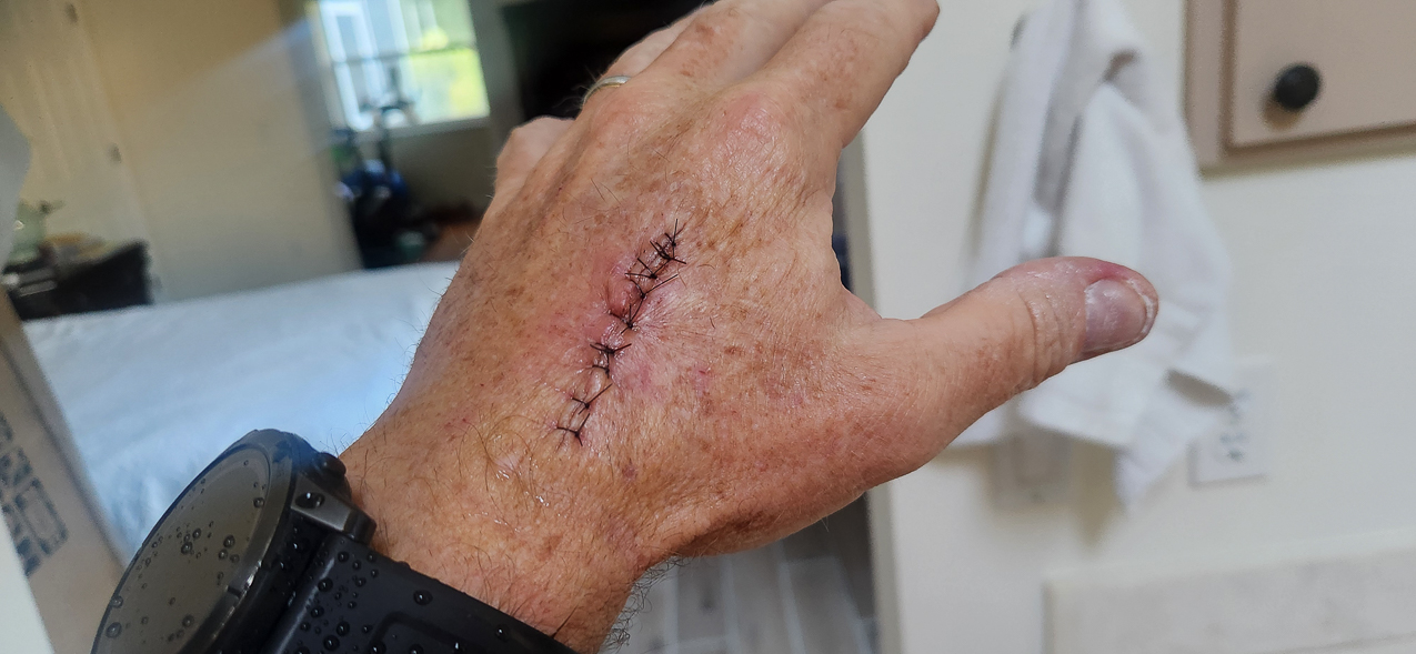 Squamous Cell Caner on my left hand  ~~  